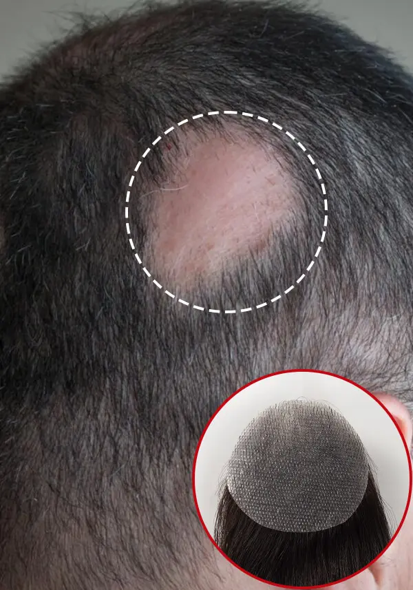 Side Patch Hair Loss for Men (2 Pieces)